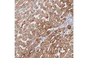 Immunohistochemical staining (Formalin-fixed paraffin-embedded sections) of human liver with TIMM8A polyclonal antibody  shows strong cytoplasmic positivity in hepatocytes.