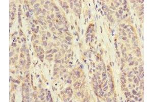 Immunohistochemistry of paraffin-embedded human ovarian cancer using ABIN7152671 at dilution of 1:100 (FCRL6 Antikörper  (AA 20-307))