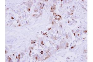 IHC-P Image Immunohistochemical analysis of paraffin-embedded human breast cancer, using MMP1, antibody at 1:250 dilution. (MMP1 Antikörper)