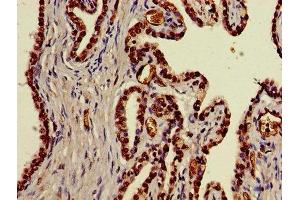 Immunohistochemistry of paraffin-embedded human prostate cancer using ABIN7170614 at dilution of 1:100 (DDX39B Antikörper  (AA 2-251))