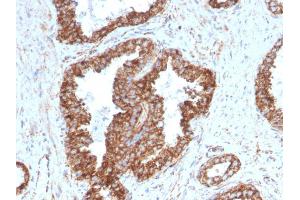 Formalin-fixed, paraffin-embedded human Prostate Carcinoma stained with PMEPA1 Mouse Monoclonal Antibody (PMEPA1/2698). (PMEPA1 Antikörper)