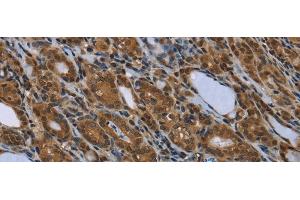 Immunohistochemistry of paraffin-embedded Human thyroid cancer using SMAD4 Polyclonal Antibody at dilution of 1/40 (SMAD4 Antikörper)