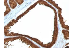 Formalin-fixed, paraffin-embedded human Colon Carcinoma stained with IDH1 Mouse Monoclonal Antibody (IDH1/1152). (IDH1 Antikörper  (AA 281-414))