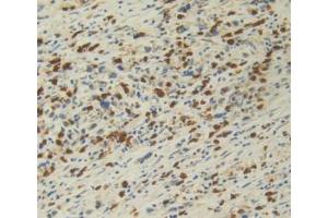 DAB staining on IHC-P; Samples: Human Stomach Cancer Tissue. (IL12A Antikörper  (AA 23-219))