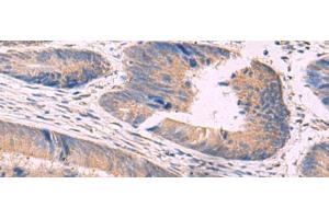 Immunohistochemistry of paraffin-embedded Human colorectal cancer tissue using NIPSNAP1 Polyclonal Antibody at dilution of 1:50(x200)