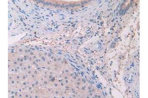 DAB staining on IHC-P; Samples: Human Glioma Tissue) (IL-33 Antikörper  (AA 112-270))