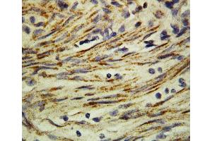 Anti-MMP16 antibody, IHC(P) IHC(P): Human Rectal Cancer Tissue (MMP16 Antikörper  (C-Term))
