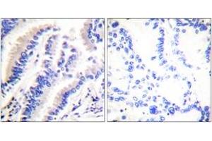 Immunohistochemistry analysis of paraffin-embedded human lung carcinoma tissue, using FADD (Ab-194) Antibody. (FADD Antikörper  (AA 159-208))