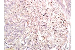 Formalin-fixed and paraffin embedded human gastric carcinoma labeled with Anti-Dnmt3a Polyclonal Antibody, Unconjugated  at 1:200, followed by conjugation to the secondary antibody and DAB staining