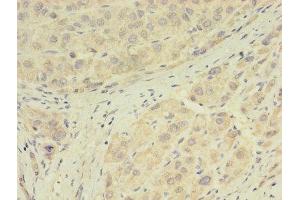 Immunohistochemistry of paraffin-embedded human liver cancer using ABIN7154076 at dilution of 1:100 (Glutathione Peroxidase 7 Antikörper  (AA 28-187))