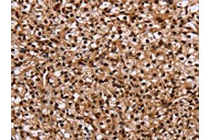 The image on the left is immunohistochemistry of paraffin-embedded Human prostate cancer tissue using ABIN7129718(HMGN5 Antibody) at dilution 1/20, on the right is treated with fusion protein. (HMGN5 Antikörper)