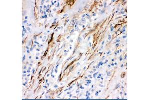 Anti- FAS Picoband antibody, IHC(P) IHC(P): Human Lung Cancer Tissue (FAS Antikörper  (AA 26-173))