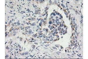 Immunohistochemical staining of paraffin-embedded Carcinoma of Human lung tissue using anti-SNAP25 mouse monoclonal antibody. (SNAP25 Antikörper)