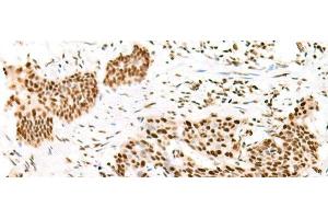 Immunohistochemistry of paraffin-embedded Human esophagus cancer tissue using TCOF1 Polyclonal Antibody at dilution of 1:50(x200) (TCOF1 Antikörper)
