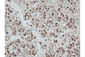 IHC-P Image Immunohistochemical analysis of paraffin-embedded human ovarian cancer, using SEPHS2, antibody at 1:100 dilution. (SEPHS2 Antikörper)