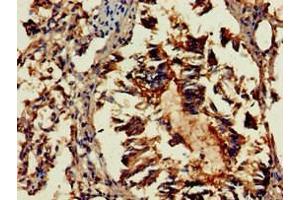 Immunohistochemistry of paraffin-embedded human lung tissue using ABIN7154436 at dilution of 1:100 (GAB2 Antikörper  (AA 273-484))