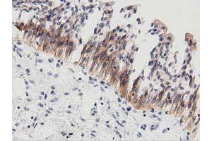 Immunohistochemical staining of paraffin-embedded Carcinoma of Human thyroid tissue using anti-PECR mouse monoclonal antibody. (PECR Antikörper)