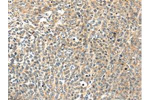 The image on the left is immunohistochemistry of paraffin-embedded Human ovarian cancer tissue using ABIN7192947(TSPYL6 Antibody) at dilution 1/20, on the right is treated with synthetic peptide. (TSPY-Like 6 Antikörper)