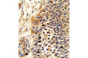 Formalin-fixed and paraffin-embedded human bladder carcinoma reacted with WNT4 Antibody (Center), which was peroxidase-conjugated to the secondary antibody, followed by DAB staining. (WNT4 Antikörper  (AA 211-239))