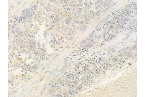 ABIN6263052 and ABIN6278809 at 1/100 staining human prostate carcinoma by IHC-P. (MAFB Antikörper  (C-Term))