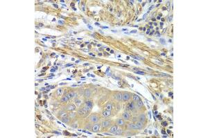 Immunohistochemistry of paraffin-embedded human gastric cancer using PICK1 antibody. (PICK1 Antikörper)