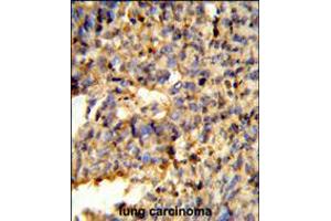 Formalin-fixed and paraffin-embedded human lung carcinoma reacted with FCGR2C Antibody , which was peroxidase-conjugated to the secondary antibody, followed by DAB staining. (FCGR2C Antikörper  (C-Term))