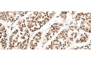 Immunohistochemistry of paraffin-embedded Human esophagus cancer tissue using HGH1 Polyclonal Antibody at dilution of 1:45(x200) (FAM203B Antikörper)
