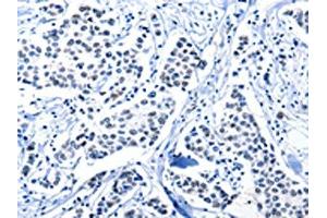 The image on the left is immunohistochemistry of paraffin-embedded Human breast cancer tissue using ABIN7191961(POU2AF1 Antibody) at dilution 1/15, on the right is treated with synthetic peptide. (POU2AF1 Antikörper)