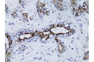 Immunohistochemistry of paraffin-embedded human breast cancer using BRCA1 antibody. (BRCA1 Antikörper  (AA 120-220))