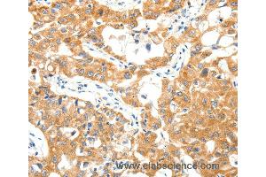 Immunohistochemistry of Human lung cancer using TRAF3 Polyclonal Antibody at dilution of 1:40 (TRAF3 Antikörper)