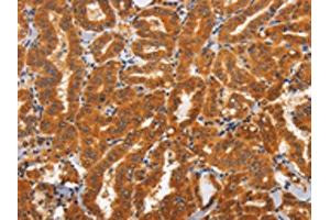 The image on the left is immunohistochemistry of paraffin-embedded Human thyroid cancer tissue using ABIN7192830(TNFRSF8 Antibody) at dilution 1/60, on the right is treated with synthetic peptide. (TNFRSF8 Antikörper)