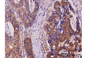 Immunoperoxidase of monoclonal antibody to KIT on formalin-fixed paraffin-embedded human stomach carcinoma. (KIT Antikörper  (AA 41-140))