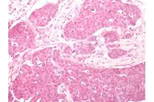 Human Breast Carcinoma: Formalin-Fixed, Paraffin-Embedded (FFPE)