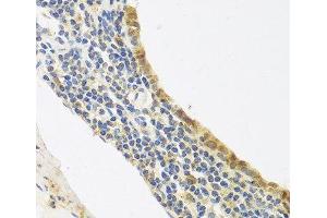 Immunohistochemistry of paraffin-embedded Human lung cancer using Endothelin 1 Polyclonal Antibody at dilution of 1:100 (40x lens).