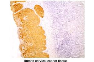 Paraffin embedded sections of human cervical cancer tissue were incubated with anti-human KRT14 (1:200) for 2 hours at room temperature. (KRT14 Antikörper)