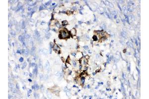 Factor B was detected in paraffin-embedded sections of human lung cancer tissues using rabbit anti- Factor B Antigen Affinity purified polyclonal antibody (Catalog # ) at 1 ?