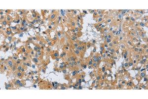 Immunohistochemistry of paraffin-embedded Human thyroid cancer using FGF9 Polyclonal Antibody at dilution of 1:40 (FGF9 Antikörper)