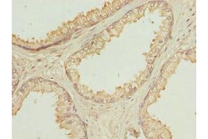 Immunohistochemistry of paraffin-embedded human prostate cancer using ABIN7162292 at dilution of 1:100 (OAZ1 Antikörper  (AA 1-68))