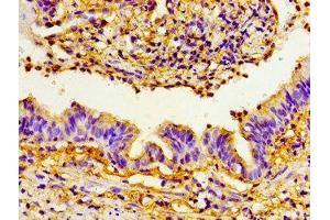 Immunohistochemistry of paraffin-embedded human lung cancer using ABIN7160458 at dilution of 1:100 (PRTN3 Antikörper  (AA 1-170))