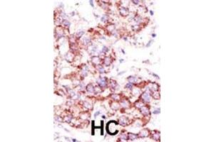 Formalin-fixed and paraffin-embedded human cancer tissue reacted with the primary antibody, which was peroxidase-conjugated to the secondary antibody, followed by AEC staining. (USP4 Antikörper  (C-Term))