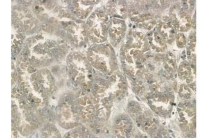 ABIN6264549 and ABIN6272406 at 1/100 staining human renal cell carcinoma by IHC-P. (RAB34 Antikörper  (Internal Region))
