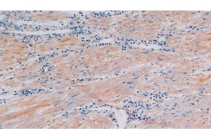 Detection of CTXI in Human Prostate Tissue using Polyclonal Antibody to Cross Linked C-Telopeptide Of Type I Collagen (CTXI) (CTX-I Antikörper)