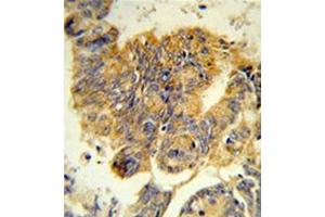 Formalin-fixed, paraffin-embedded human colon carcinoma reacted with CD114 / CSF3R Antibody (Center) Cat. (CSF3R Antikörper  (Middle Region))