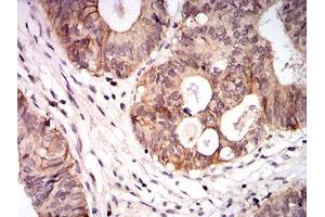 Immunohistochemical analysis of paraffin-embedded colon cancer tissues using CPV-VP2 mouse mAb with DAB staining. (CPV-VP2 (AA 1-128) Antikörper)