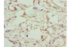 Immunohistochemistry of paraffin-embedded human pancreatic cancer using ABIN7154064 at dilution of 1:100 (GGTLC1 Antikörper  (AA 1-225))