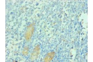 Immunohistochemical of paraffin-embedded human gastric cancer tissue using ABIN7163025 at dilution of 1:200 (PGC Antikörper)