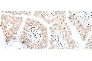 Immunohistochemistry of paraffin-embedded Human liver cancer tissue using NGEF Polyclonal Antibody at dilution of 1:35(x200) (NGEF Antikörper)