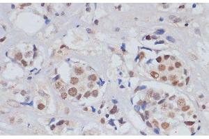 Immunohistochemistry of paraffin-embedded Human breast cancer using SKIV2L2 Polyclonal Antibody at dilution of 1:100 (40x lens). (MTR4 Antikörper)