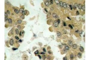 Immunohistochemistry analysis of Akt2 antibody in paraffin-embedded human lung carcinoma tissue. (AKT2 Antikörper)