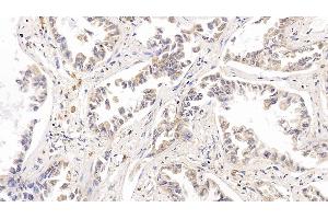 Detection of RRM1 in Human Lung cancer Tissue using Polyclonal Antibody to Ribonucleotide Reductase M1 (RRM1) (RRM1 Antikörper  (AA 1-213))